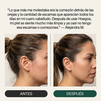 Hoegoa® Exfoliante Capilar Natural